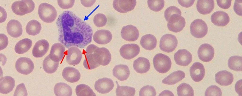 Hyposegmented in sepsis, MDS Hyperlobated in B12