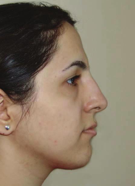 28 months after nasal hump