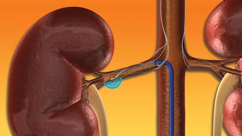 Renal Nerve Anatomy Allows a Catheter-Based Approach Standard
