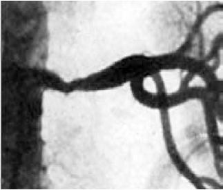Atherosclerotic RAS Older men Ostial or proximal 1/3 of vessel Stenosis HTN Renovascular HTN Clinical Features Suspected when: New HTN < 30 or > 55 years old Unexplained renal dysfunction