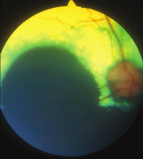 CE 23 Figure 5. Canine fundus photograph of a mass with the typical appearance of a choroidal melanoma. The mass is a raised, circular, darkly pigmented, subretinal lesion. mation.