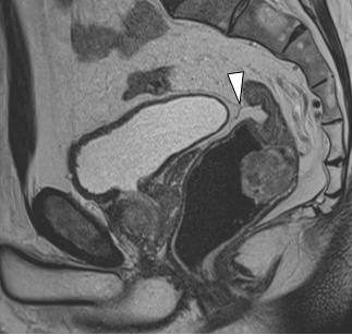 cases on sagittal T2 weighted images, appearing as a thin, low signal line extending approximately from the posterior aspect of the dome of the bladder to the ventral aspect of the rectum (Figure 2).