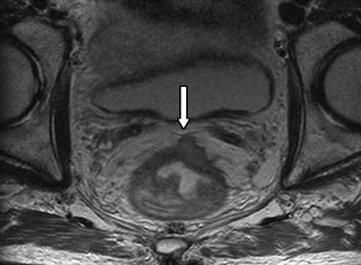 Based on this assessment, the radiologist determines whether the tumor is above, below, or straddles (extends both above and below) the anterior peritoneal reflection.