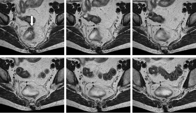 Figure 4: The point at which the peritoneal reflection commences can also be recognized on serial axial MRI through the mesorectum showing the anterior mesorectal fat becoming thinner and thinner.