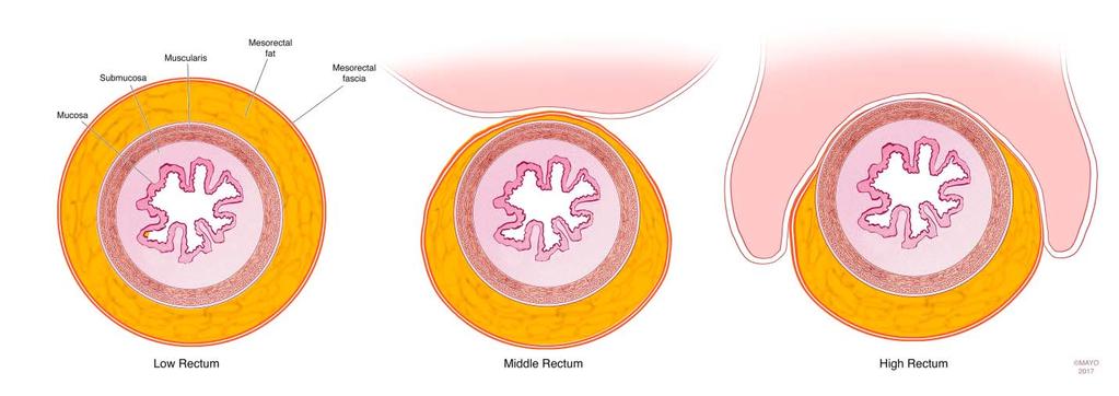 Figure 8: Schematic illustration demonstrating rectal wall layers, mesorectal fat and mesorectal fascia in the lower rectum.