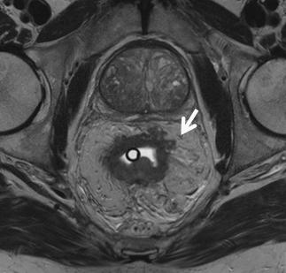 rectal wall in two different patients (arrows).