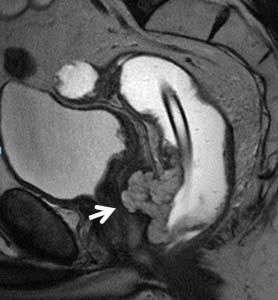 In the second image, the tumor penetrates through the wall at multiple locations and the white arrow points to the area with the greatest extramural depth
