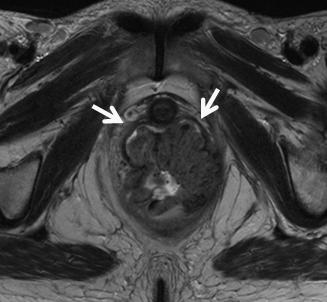 Figure 11: MRI Category T4a Sagittal T2W image demonstrates a T4a rectal tumor penetrating through the rectal wall and involving the peritoneal reflection