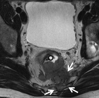 Figure 13: MRI category T4b Axial T2W image demonstrates T4b disease with bulky tumor invading the sacrum (white arrows).