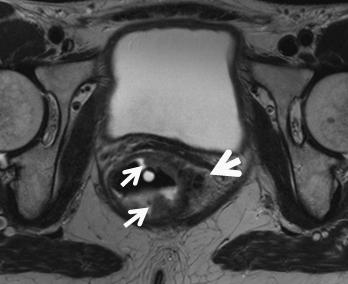 Perirectal invasion most often appears with a broad based, pushing margin, but can be seen as finger like extensions of intermediate signal intensity extending into the mesorectal fat.