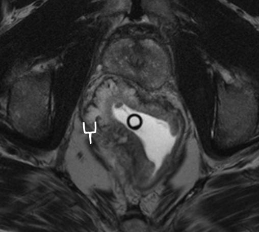 EMD is measured for the definitive tumor border only and does not include