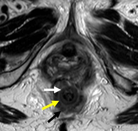 Low rectal tumors in which the lower margin of the tumor is above the top border of puborectalis may be amenable to sphincter sparing low anterior resection and should be reported similarly to upper