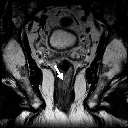 Figure 20 Low rectal tumor with involvement of the internal