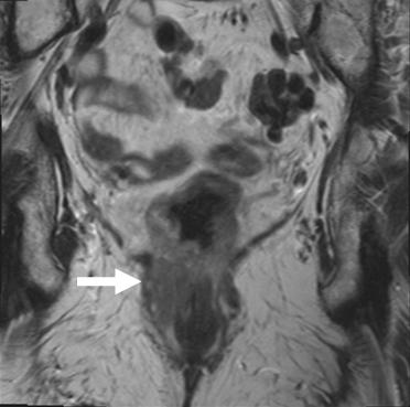 Figure 24 Coronal T2 weighted images shows low rectal tumor invading