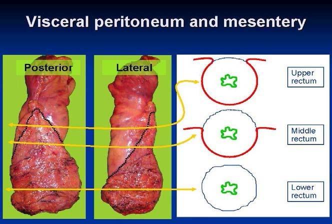 (4) Circumferential Resection Margin Background: In order to accurately stage rectal cancer, the reader must have an understanding of the peritoneal and extraperitoneal planes.