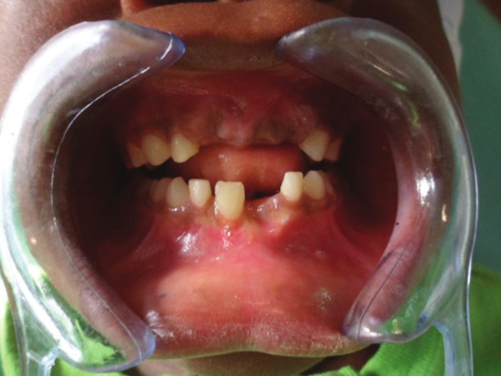 segment at the symphyseal region. There was no individual tooth fracture present and no tooth in the line of fracture was mobile. There was no fracture elsewhere.