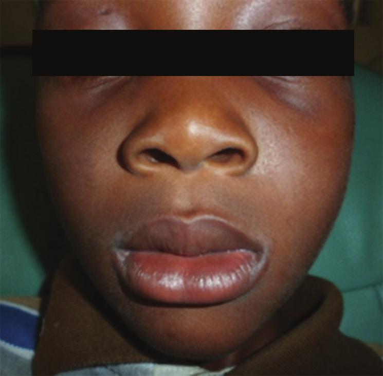 Figure 6: Intraoral picture of the patient at 3 year follow up showing a maintained healthy dentition in centric occlusion.