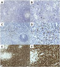 + T-lymphoblastic cells are increased in Castleman disease and FDCS/FDCT + T-lymphoblastic cells are increased in