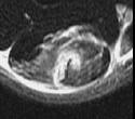 Patellar cartilage tear (ultrasound only see