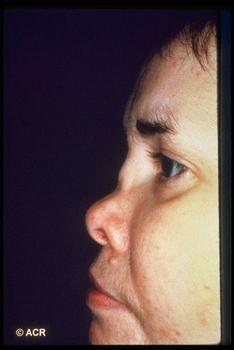 Saddle nose deformity Relapsing polychondritis May also occur in syphilis and ANCA associated