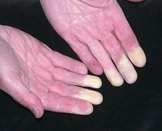 Case 3: Miss Frosty A 32yo previously healthy woman presents with fingers that