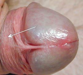 When the foreskin is retracted, the main part of the ridged band lies