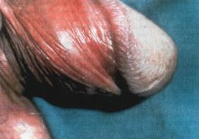 On the underside of the penis, the ridged band merges into the frenulum of