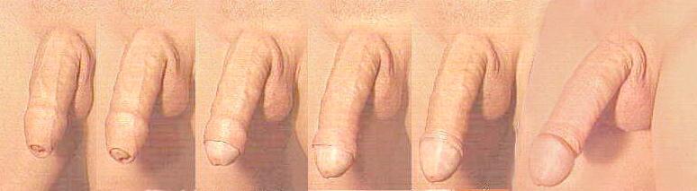 THE RETRACTION PROCESS As it changes from flaccidity to rigidity with erection, the penis increases in length about 50%.