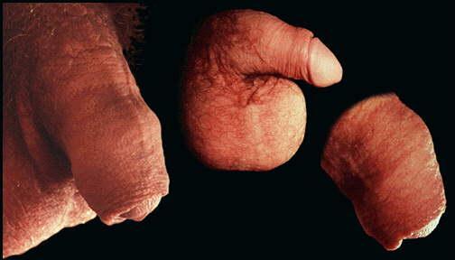 THE INTACT ADULT PENIS Foreskin covering the glans; the foreskin when retracted; and a closeup of the foreskin covering the