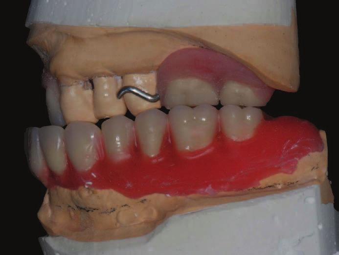 prosthetic volume. Here, mention is made of assisted surgery.