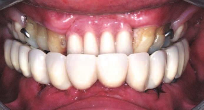 Figure 6. Panoramic X-ray 5 hours after setting the implants. Teeth were then mounted according to the validated diagnostic this case, a self-polymerized resin, and set in the mouth (Figure 5 and 6).