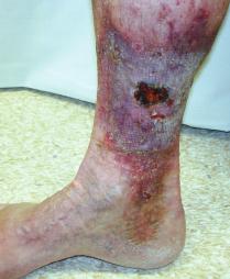Identification and recommended management of leg ulcers Jill Robson RGN and Gerard Stansby MA, MChir, FRCS thickened skin, lipodermatosclerosis skin stained haemosiderin shallow ulcer irregular shape