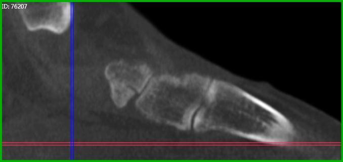 Case C (Figure 3): PedCat CBCT sagittal plane reconstruction of navicular tuberosity fracture.