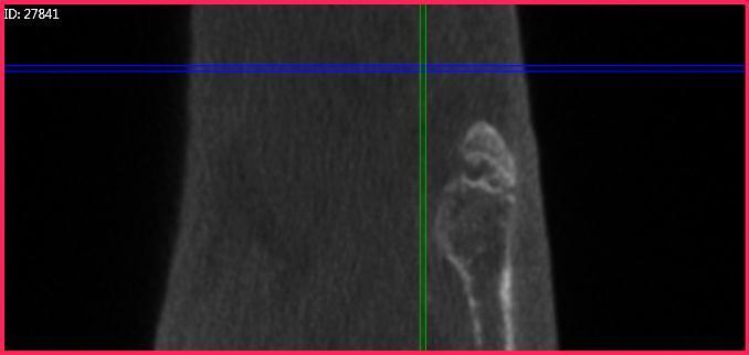 The fracture gap is most pronounced along the plantar margin with bony contact, but not bony bridging dorsally.