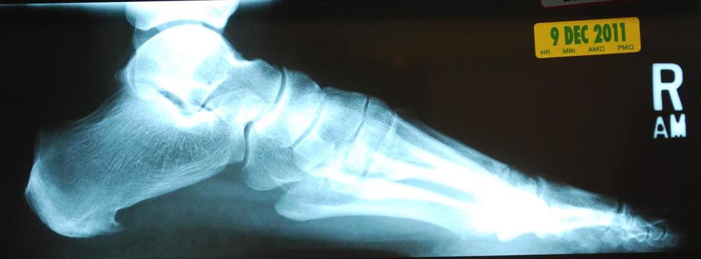 Case E (Figure 2): Lateral radiograph of suspected metatarsal head osteotomy nonunion.