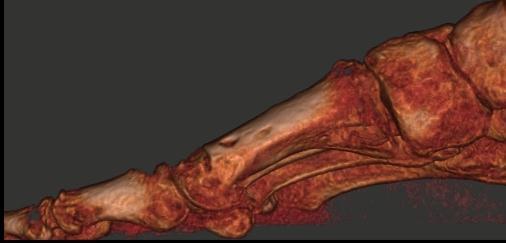 Case E (Figure 5): PedCat CBCT 3-D reconstruction of metatarsal head osteotomy nonunion.