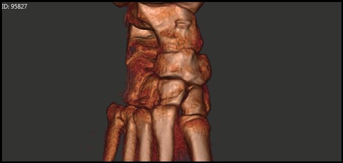 Section 3: Foot Subluxations and Dislocations Case Study F: Lisfranc s Midfoot Dislocation Clinical History: J.K. a 28 year old female presents complaining of a painful right foot.
