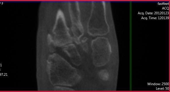 Case G (Figure 1): PedCat CBCT chronic Lisfranc dislocation with post-traumatic arthritis.
