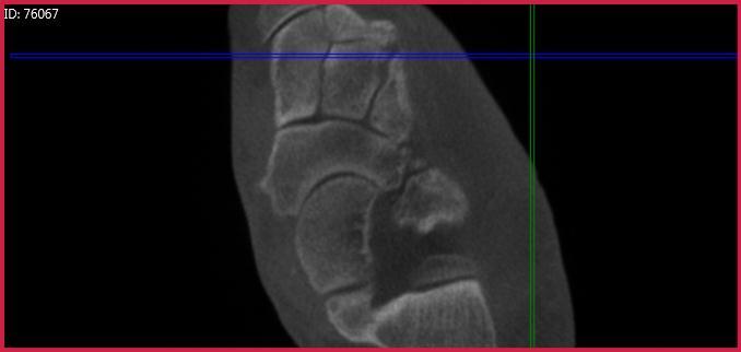 More surprising, the transverse plane view identified a cuboid-navicular coalition.
