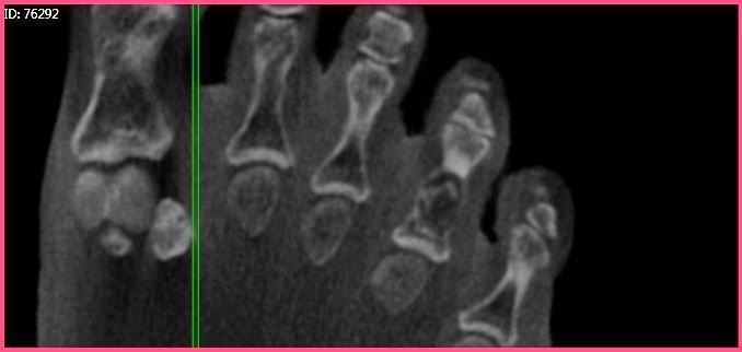 PedCat CBCT Findings (Figures 2 & 3): The sagittal and transverse plane reconstructions demonstrate the dilation or expansion