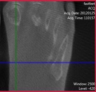 Case O (Figure 2): PedCat CBCT transverse plane reconstruction demonstrating a large bone cyst encompassing the majority of the first metatarsal head a
