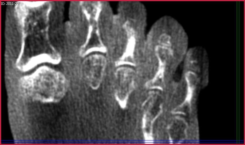 X-Ray Findings: Plain x-rays were inconclusive for osteomyelitis.