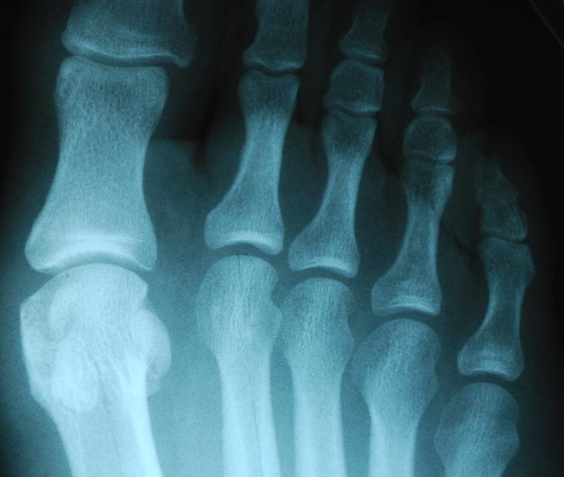 Section 1: Foot Fractures Case Study A: Sesamoid Fracture(s) Clinical History: C.E. a 30 year old male sustained an acute injury to the right great toe and sesamoids while playing soccer.