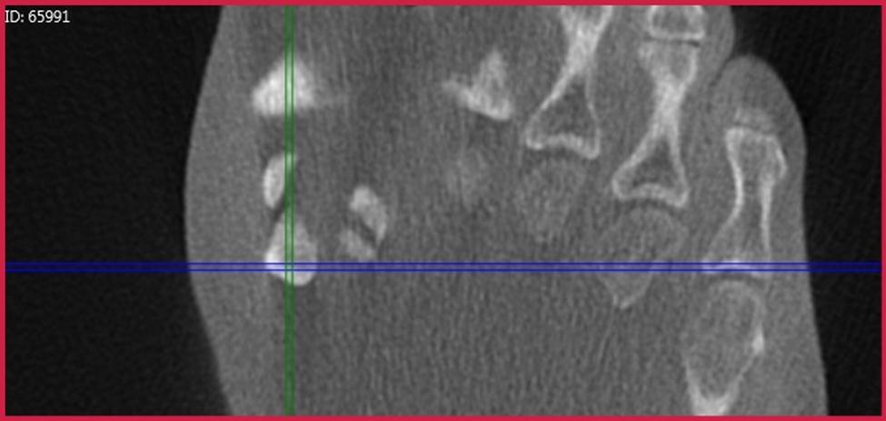 Case A (Figure 2): PedCat CBCT transverse plane reconstruction demonstrating medial and lateral sesamoid fractures.