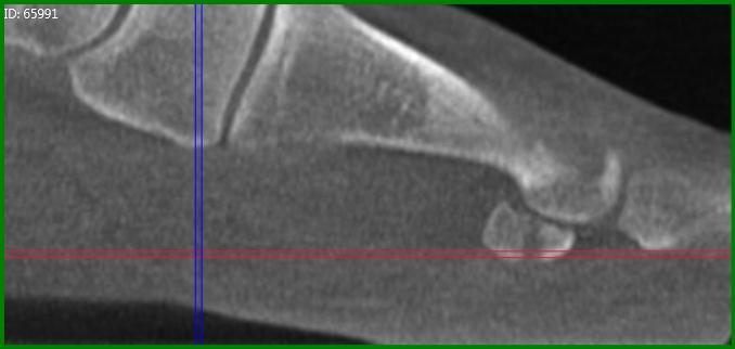Clinical Relevance of the PedCat Study: The plain radiographs clearly demonstrated the medial sesamoid fracture, thus the PedCat did not alter the treatment course for treating the medial sesamoid.