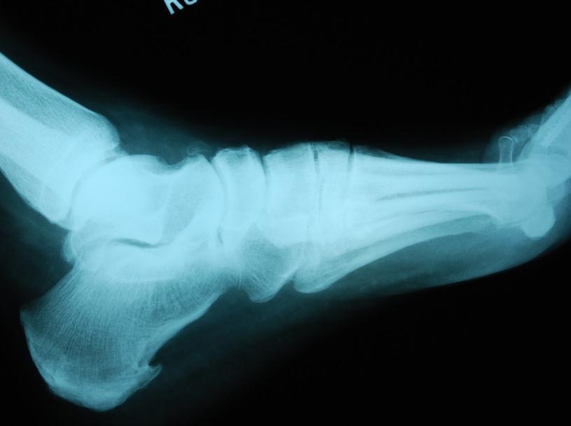Case Study B: Charcot Neuropathic Anterolateral Calcaneal Fracture Clinical History: C.Y.