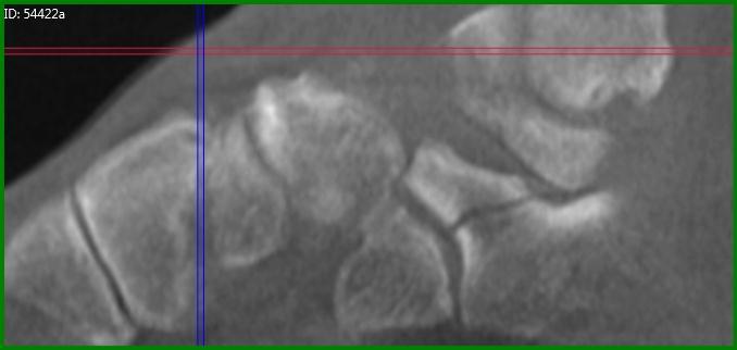 planes clearly demonstrate a minimally displaced (1mm) anterolateral calcaneal fracture.
