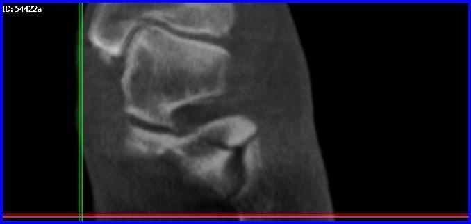 Case B (Figure 2): PedCat CBCT frontal plane reconstruction of anterolateral calcaneal fracture.