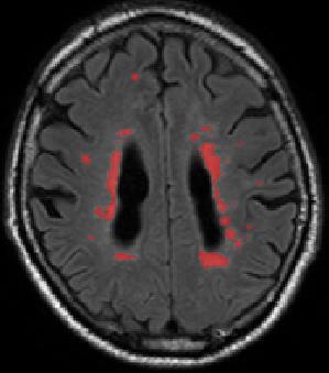 The red pixels indicate the WMH annotated by a neuroradiologist. feature representation of small lesions tend to be trivial when image features are extracted in a global manner.