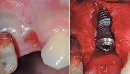 advanced ap. Both require a good donor sample of connective tissue obtained from the palatal masticatory mucosa.